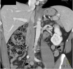 Retroaortic Left Renal Vein - CTisus CT Scan