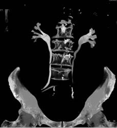 Ileal Loop S/P Cystectomy - CTisus CT Scan