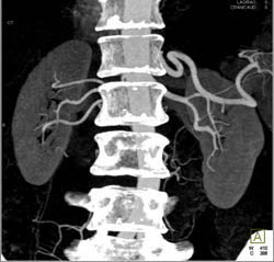 3D Mapping of Renal Donor- 2 Right Renal Arteries With Prehilar Branching - CTisus CT Scan