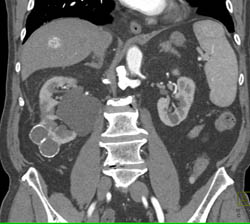 Cystic Renal Cell Carcinoma - CTisus CT Scan