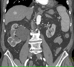 Cystic Renal Cell Carcinoma - CTisus CT Scan