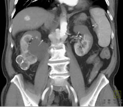 Cystic Renal Cell Carcinoma - CTisus CT Scan