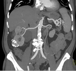 Cystic Renal Cell Carcinoma - CTisus CT Scan