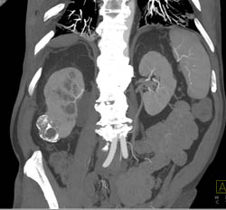 Cystic Renal Cell Carcinoma - CTisus CT Scan