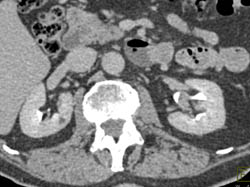 Transitional Cell Cancer (TCC) of the Left Kidney- See Full Sequence - CTisus CT Scan