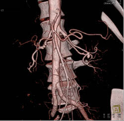 Fibromuscular Dysplasia Right Renal Artery and A Less Than 1cm Aneurysm Left Renal Artery- See Full Sequence - CTisus CT Scan