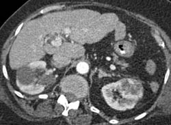 Renal Cell Carcinoma- Incidental Finding - CTisus CT Scan