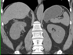 Vascular Clear Cell Carcinoma- See Full Sequence of Images - CTisus CT Scan