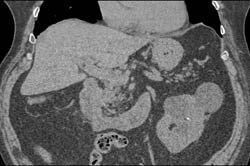 Obstructing Stones in Proximal Right Ureter - CTisus CT Scan