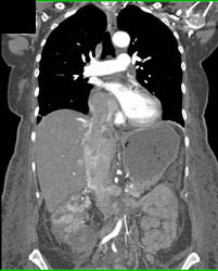 Renal Cell Carcinoma Invades IVC and Extends Into Right Atrium- See Full Sequence of Images - CTisus CT Scan