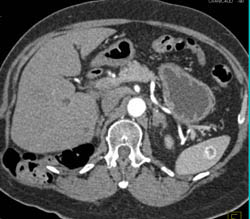 Recurrent Renal Cell Carcinoma to the Spleen - CTisus CT Scan