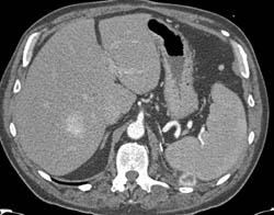 Recurrent Renal Cell Carcinoma With Liver, Muscle, and Peri-splenic Metastases - CTisus CT Scan