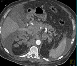 Lymphoma Involves Both Para-renal Spaces - CTisus CT Scan