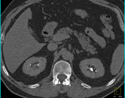 Transitional Cell Cancer (TCC) Right Kidney- Multifocal - CTisus CT Scan