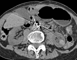 High Density Renal Cyst- See Full Sequence - CTisus CT Scan