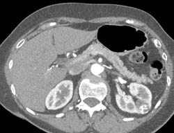 Incidental 1cm Vascular Left Renal Cell Carcinoma - CTisus CT Scan