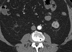 Subtle 1cm Renal Cell Carcinoma - CTisus CT Scan