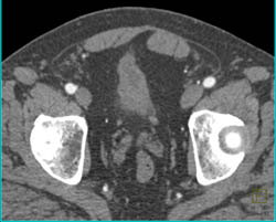 Urachal Remnant- See Full Sequence - CTisus CT Scan