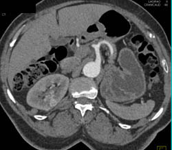 Post Left Nephrectomy Changes With 1cm Right Renal Cancer - CTisus CT Scan