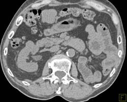 Left Nephrectomy With 1.5cm Right Renal Cell Carcinoma - CTisus CT Scan