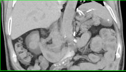 1cm Renal Cell Carcinoma (RCC) - CTisus CT Scan