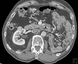 Vascular Renal Cell Carcinoma - CTisus CT Scan