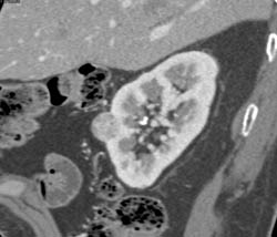 Vascular Renal Cell Carcinoma - CTisus CT Scan