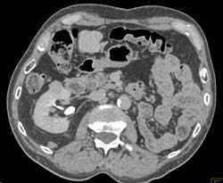 Vascular Renal Cell Carcinoma - CTisus CT Scan