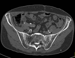 Stress Fracture Simulates Metastases - CTisus CT Scan