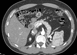 Post Left Nephrectomy - CTisus CT Scan