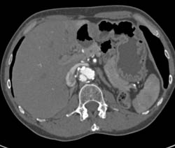 Horseshoe Kidney - CTisus CT Scan