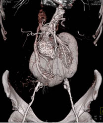 Horseshoe Kidney - CTisus CT Scan