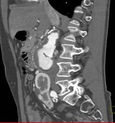 Horseshoe Kidney - CTisus CT Scan