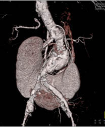 Horseshoe Kidney - CTisus CT Scan