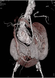 Horseshoe Kidney - CTisus CT Scan