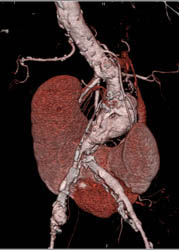 Horseshoe Kidney - CTisus CT Scan