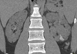 Renal Angiomyolipomas (AMLs) With Various Range of Intrarenal Fat - CTisus CT Scan