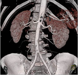 Prehilar Branching Right Renal Artery - CTisus CT Scan