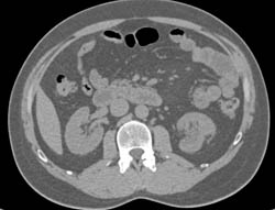 Left Renal Transitional Cell Cancer (TCC) - See Full Sequence - CTisus CT Scan