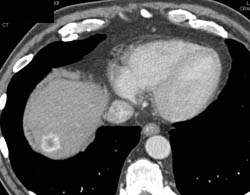 Metastatic Renal Cell Carcinoma to Spleen, Liver, and Nodes- See Right Nephrectomy - CTisus CT Scan