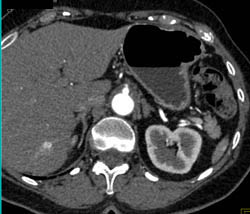 Renal Cell Carcinoma - CTisus CT Scan