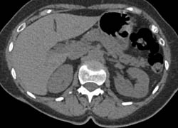 Renal Cell Carcinoma - CTisus CT Scan