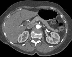 Renal Cell Carcinoma - CTisus CT Scan