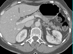 Renal Cell Carcinoma - CTisus CT Scan