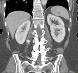 Renal Cell Carcinoma - CTisus CT Scan