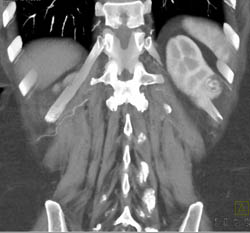 Renal Cell Carcinoma - CTisus CT Scan