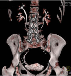 Duplicated Collecting System With Nice Demonstration of Bladder - CTisus CT Scan