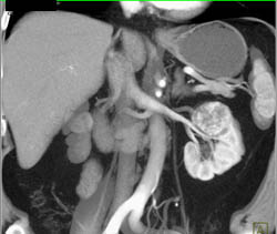 Renal Cell Carcinoma - CTisus CT Scan