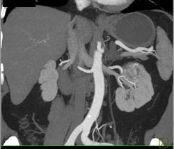 Renal Cell Carcinoma - CTisus CT Scan