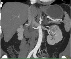 Renal Cell Carcinoma - CTisus CT Scan